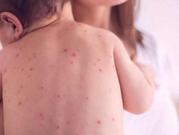 ХӨСҮТ: Улаанбурхан өвчний батлагдсан тохиолдол хоёроор нэмэгджээ