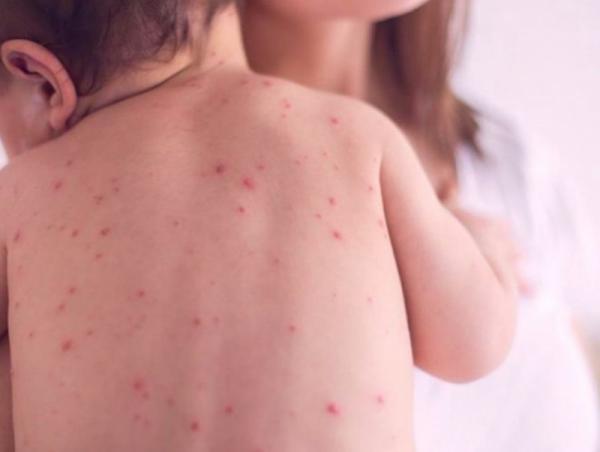 ХӨСҮТ: Улаанбурхан өвчний лабораториор батлагдсан тохиолдол 9833 болжээ